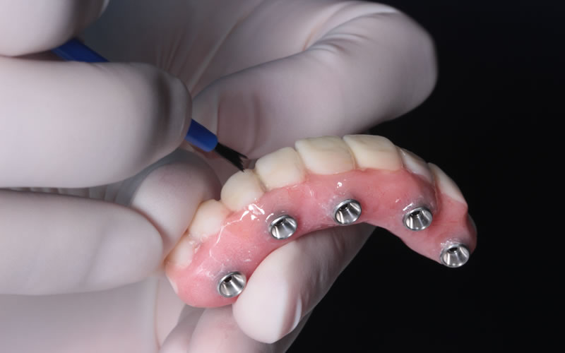 Implantología Oral y Reconstructiva