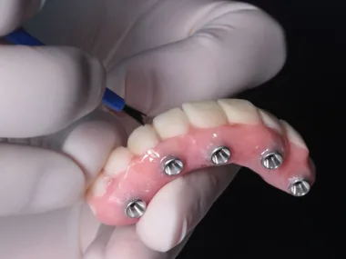 Implantología Oral y Reconstructiva