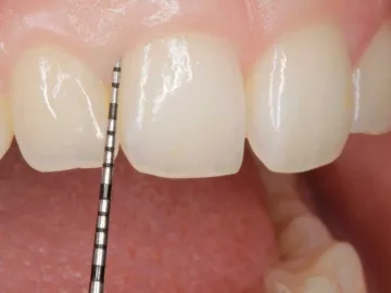 Periodoncia