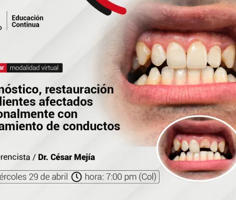 WEBINAR: Restauración de dientes afectados coronalmente con tratamiento de conductos