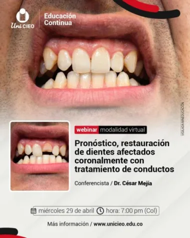 WEBINAR: Restauración de dientes afectados coronalmente con tratamiento de conductos