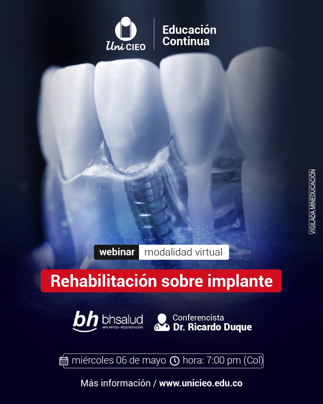 Rehabilitación sobre implantes
