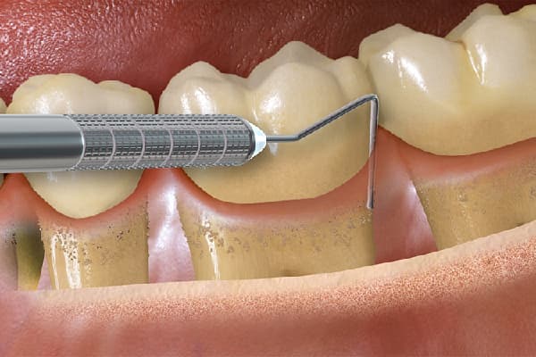 Periodoncia