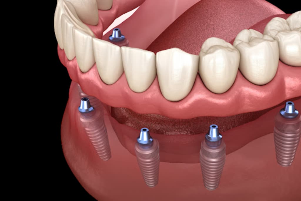 Rehabilitación Oral